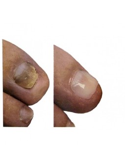 Gehwol Nail Repair Gel Opal...