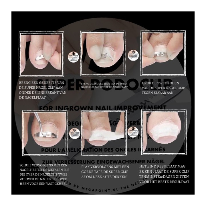 Super Podoclip Nagelbeugel Techniek